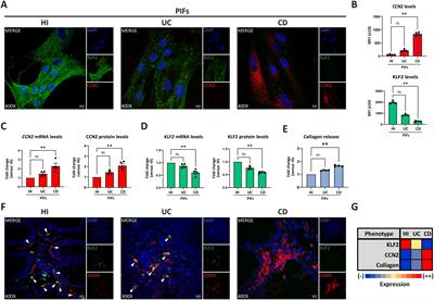 Neutrophil-fibroblast crosstalk drives immunofibrosis in Crohn’s disease through IFNα pathway